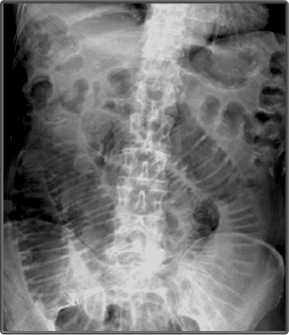 Intestines X-ray